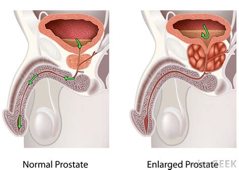 One of the things to watch out for is the color of your urine as it could help you detect if you have prostate cancer or not. What Is the Prostate Gland? (with pictures)