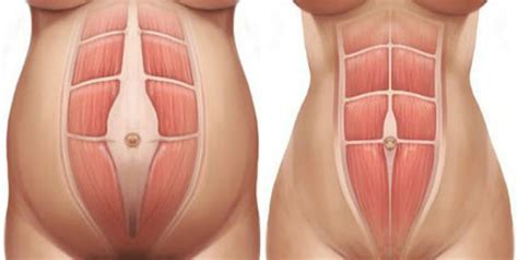 Maybe you would like to learn more about one of these? Diastasis Recti postnatal postpartum | Pilates & Barre ...