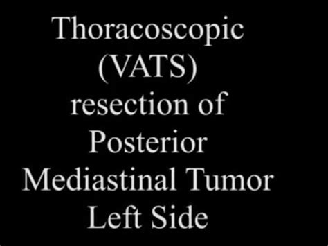 With treatment, patients have an average life expectancy of one to two years. Records Of Mesothelioma Icd 10