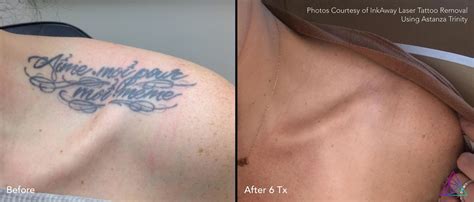 Maybe you would like to learn more about one of these? Best Completed Tattoo Removal: InkAway Laser Tattoo ...