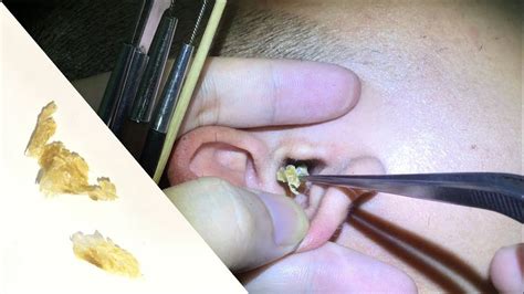The first step in ear cleaning is moistening the earwax using mineral oil and an eyedropper. ways to clean your ears #20 - YouTube