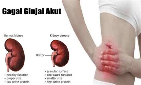 Disebabkan itu semasa mengisi borang bsh, adalah diwajibkan mengisi ruangan waris. Apa Itu Gagal Ginjal Akut. - Kantong Obat.