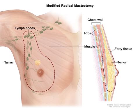 There are many organizations that support breast cancer awareness month and provide assistance within early still, it's important to let your doctor know about any lumps or changes in your breast that you find. Male Breast Cancer Treatment (PDQ®)-Patient Version ...