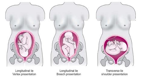 Apabila berat badan janin dinyatakan kurang dari berat badan ideal di usia kandungan tersebut, dokter kandungan akan meminta ibu untuk mengonsumsi makanan tertentu terutama yang kalorinya tinggi. Kedudukan Bayi Yang Tidak Normal Ketika Di Dalam Kandungan ...