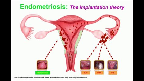 Endometriose — endométriose l endométriose est la présence de cellules endométriales en dehors de la cavité utérine (cavité péritonéale et ovaire). Endométriose pelvienne profonde : stratégie et résultats ...