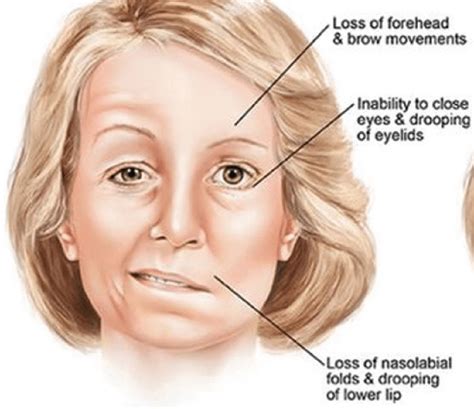 Bell's palsy and stroke tend to mimic each other because of some of the presenting signs of these conditions. Everything about Bell's Palsy | News | Dentagama