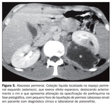 Pielonefrite aguda é o termo hoje recomendado pela sociedade internacional de urorradiologia para denominar o processo. Freqüência dos sinais de pielonefrite aguda em pacientes ...