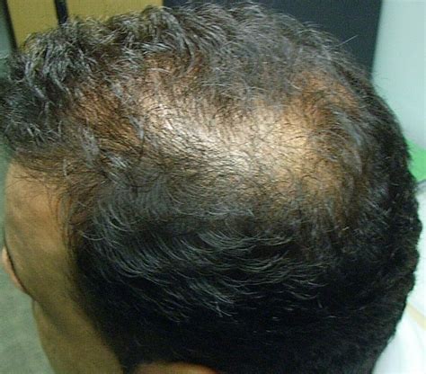 We have treated patients with aga for seven years. The Hair Centre | Asian Hair Loss ( male )BEFORE