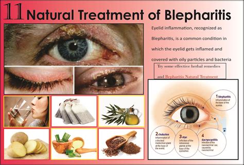 Redness, itching, tearing, and blurry vision are symptoms and signs. Blepharitis Homeopathic Remedy - Homemade Ftempo