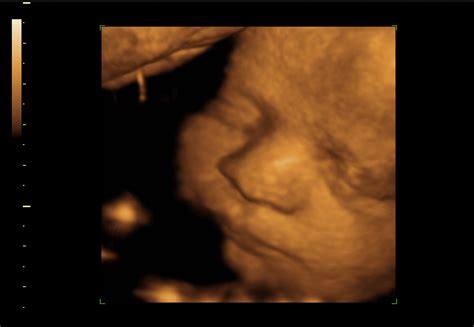 Choices care center offers ultrasounds and other pregnancy health services to women of all ages. Ultrasound Orange CA | ultrasound clinic Near Me | Fetal ...