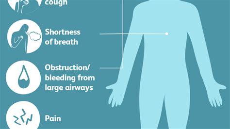 Squamous cell carcinoma cat cancer prognosis. How Long Do You Live With Lung Cancer Stage 4 - CancerWalls