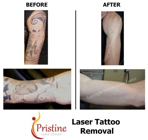 Enlighten pico tattoo removal will remove tattoo permanently from your body without any pain. Picosure Tattoo Removal Orlando Florida | Picosure Laser - Pristine Laser Center Orlando