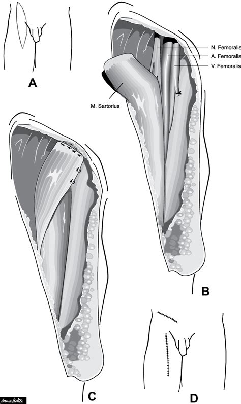 Start studying medial thigh muscles (groin). (A) Ellipse shaped incision. (B) The origin of the ...