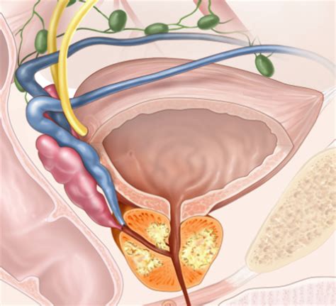 The problem is how to tell the aggressive cancers from the harmless warty growths. Low-Grade Prostate Cancers May Not Become Aggressive With ...