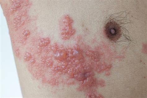 Herpes zoster infection | The BMJ