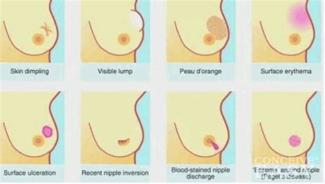 Sudden and unexplained weight loss, rectal bleeding or blood in the stool are all cause for concern, says richards. Do Fertility Treatments Cause Breast Cancer ...
