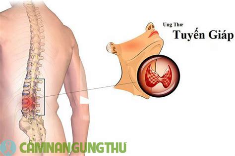 Bệnh không có dấu hiệu rõ ràng, âm thầm di căn đến nhiều bộ phận khác. Ung thư tuyến giáp di căn là gì? Có nguy hiểm không?