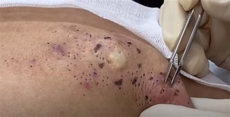 This is pimple popping #5 by chanthanuthly on vimeo, the home for high quality videos and the people who love them. youtube videos of blackheads | New Pimple Popping Videos
