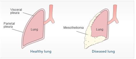 The main emphasis is on recent scientific developments in all. Mesotelioma pleural