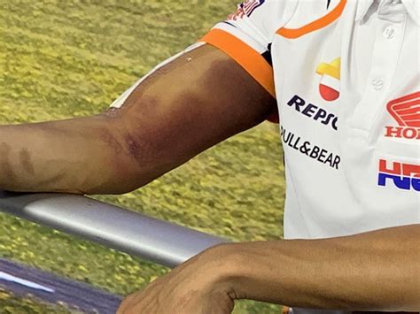 Motogp 'alien' marc marquez defies the laws of physics again by beating his own lean angle record at the italian motogp. Marc Márquez : arm Marc Márquez riding days operation ...