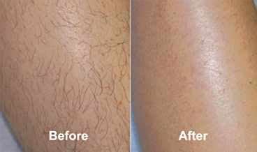 It fight against the rosacea and is fast, effective. Revitol Hair Removal Cream Review