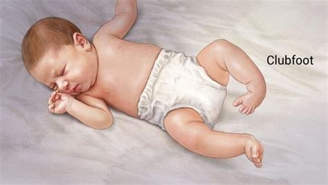 The affected foot and leg may be smaller in size compared to the other. Handle with care - early identification of neonatal ...