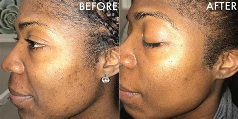 It is obvious that microneedling in addition to minoxidil application is much more effective at inducing hair growth than just. Shedding Microneedling - How Scalp Microneedling Can Cause ...