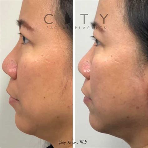 NYC Threadlift Before and After Pictures | New York | UES