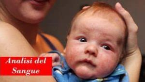 DERMATITE ATOPICA cause sintomi cure - ANALISIDELSANGUE.NET