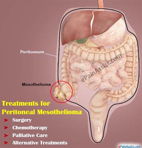 The same test identified rmh in 100% of rmh cases. Peritoneal Mesothelioma Symptoms