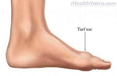 Early surgery for turf toe is indicated when large tears are present, in cases of joint instability, or when sesamoid diastasis or migration is present14. Turf Toe Definition, Causes, Symptoms, Complications and ...