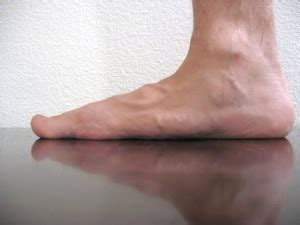 Can anything be done to fix flat feet? Build Arches With Flat Feet Treatment - Core Walking