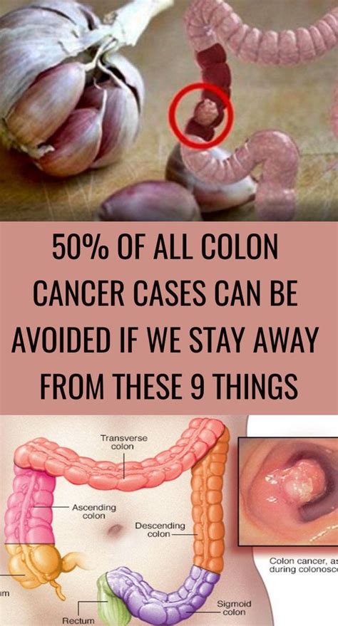 The purpose of cancers is emotional security, sexual and intellectual instincts. 50% of All Colon Cancer Cases Can Be Avoided If We Stay ...