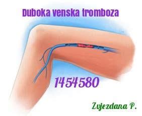 Venska tromboza je bolest krvožilnog sustava. venska tromboza Trombose veineuse profonde (com imagens ...