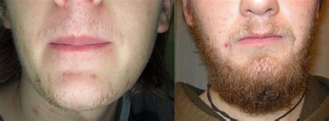 I will continue the treatment and recomend 100%! Is there a Rogaine for mustaches? - Bodybuilding.com Forums