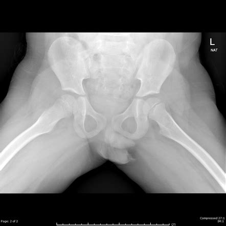 We are pleased to provide you with the picture named pelvis x ray anatomy. Pelvis radiograph (paediatric) | Radiology Reference ...