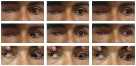 Cfeom syndrome is a genetic figure 1: Miosis in a case of congenital fibrosis of extraocular muscles: a rare presentation of a rare ...