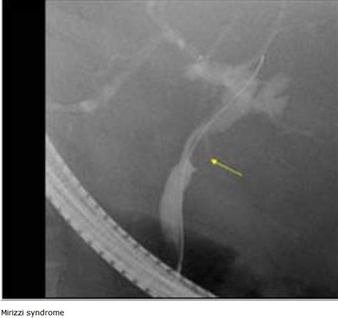 Acholīe — (griech.), fehlen der galle; Das Mirizzi Syndrom - MTA-R.de