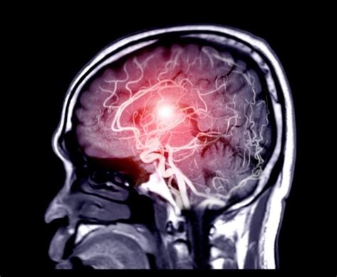 Autopsy study shows Covid harms brain like Alzheimer's, Parkinson's 