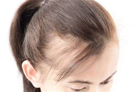 Chez la femme, la perte capillaire saisonnière est normale. Perte Cheveux Localisée Femme : Les pertes de cheveux chez ...
