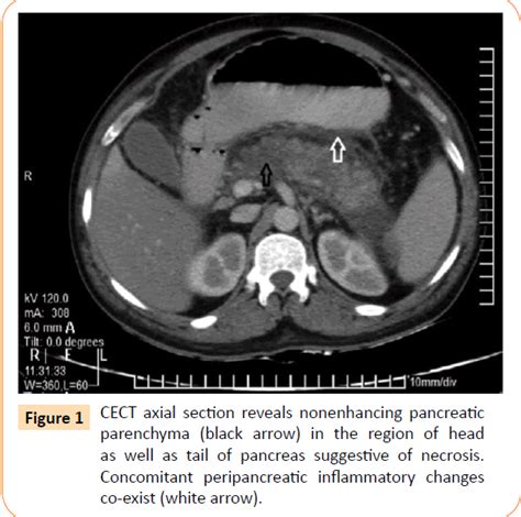 If you've been told that you or a family member has high platelets, you're probably wondering what exactly this means. Anicteric Leptospirosis: An Unusual Cause of Acute ...