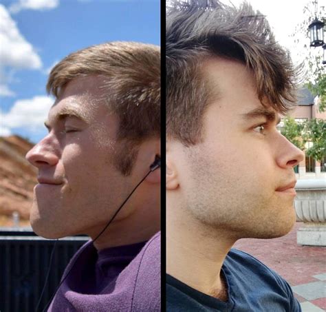 How can i fix my underbite naturally. M/25/5'11" 225lb > 225lb I had double jaw surgery last ...