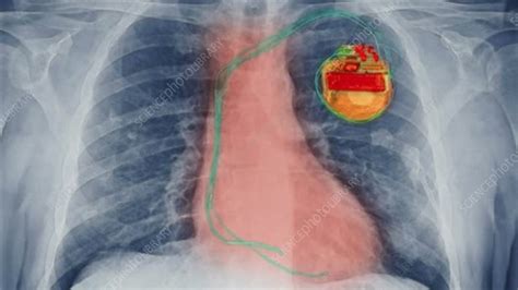 Pacemaker & icd are two different devices. Pacemaker, X-ray - Stock Video Clip - K005/1056 - Science ...