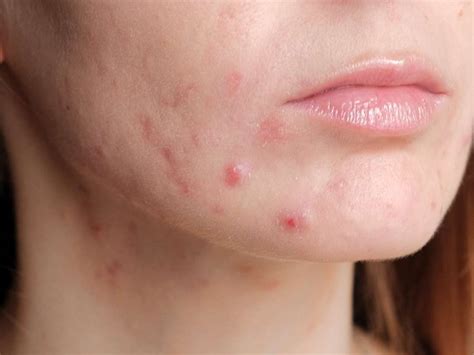 Excess stress leads to inflammation and therefore, acne. Pin on dermatology