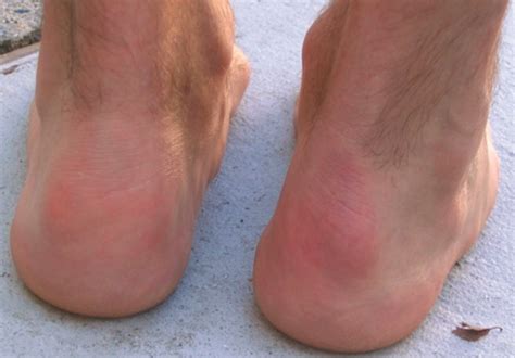 Haglund's deformity is an abnormality of the foot. Deformidade de Haglund - Entesopatia do Aquiles - Dr ...