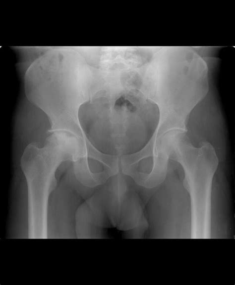 Avascular necrosis (avn), also called osteonecrosis or bone infarction, is death of bone tissue due to interruption of the blood supply. Avascular necrosis of the hip | Radiology Case ...