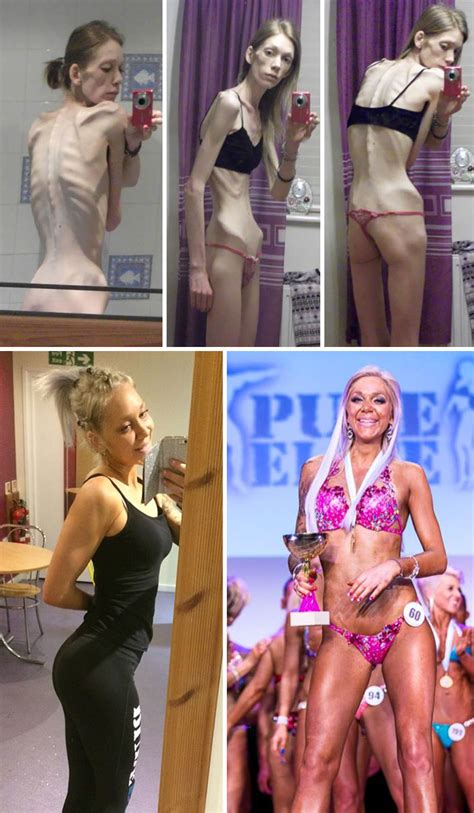 Isabel raad hei og velkommen till min kanal! 10+ Before & After Pics Of People Who Defeated Anorexia ...