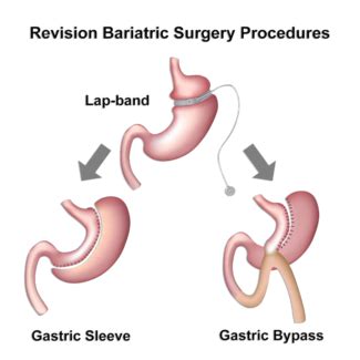 Gastric bypass is a surgery that connects your upper stomach and lower stomach. Revision Weight Loss Surgery - Tijuana, Mexico - Dr ...