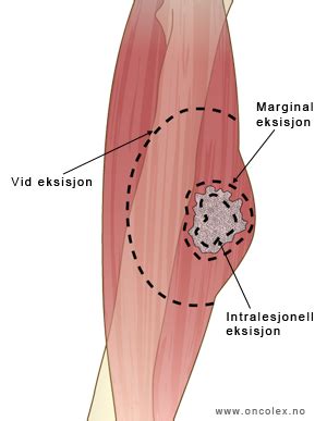 Denne funksjonen er fjernet av personvernshensyn. Kirurgisk behandling ved bløtvevssarkom i arm, ben og ...