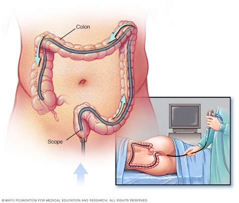 If you notice any of the. Diagnosis - Colon cancer - Mayo Clinic